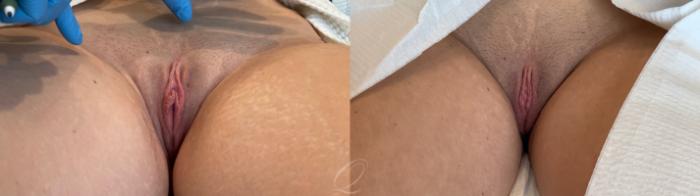Labiaplasty Case 1001544 Before & After Front | Serving Rochester, Syracuse & Buffalo, NY | Quatela Center for Plastic Surgery