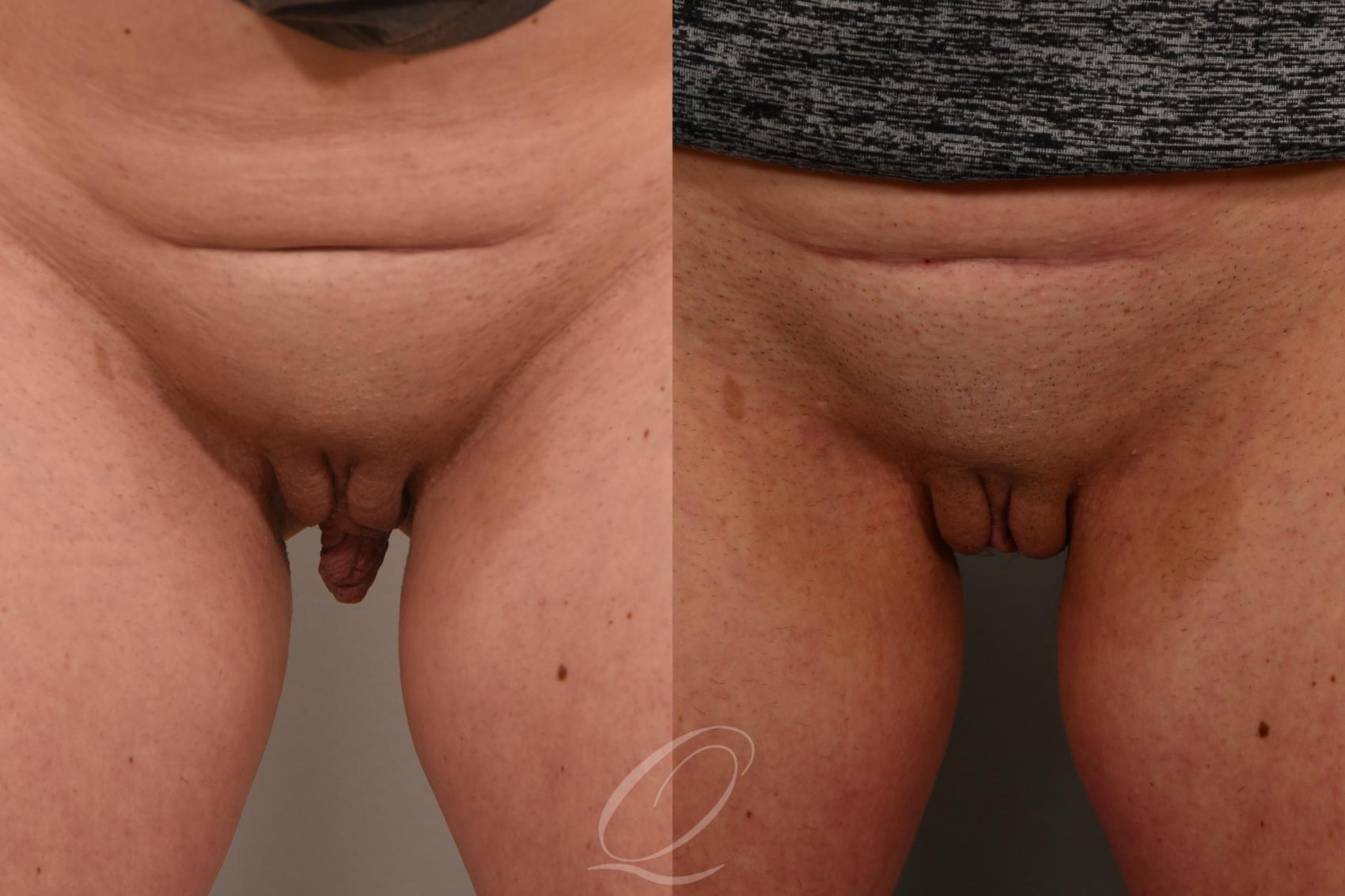 Labiaplasty Case 1001659 Before & After Front | Serving Rochester, Syracuse & Buffalo, NY | Quatela Center for Plastic Surgery