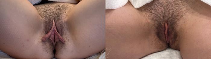 Labiaplasty Case 1001730 Before & After Front | Serving Rochester, Syracuse & Buffalo, NY | Quatela Center for Plastic Surgery