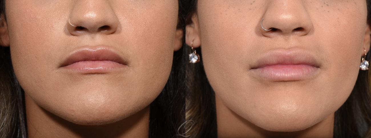 Lip Augmentation Case 367 Before & After View #1 | Serving Rochester, Syracuse & Buffalo, NY | Quatela Center for Plastic Surgery