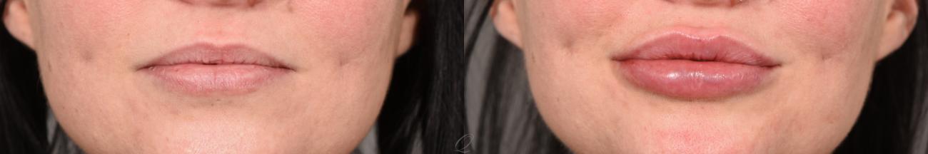Juvederm™ Case 387 Before & After View #1 | Serving Rochester, Syracuse & Buffalo, NY | Quatela Center for Plastic Surgery