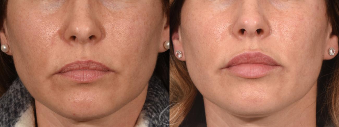 Lip Augmentation Case 398 Before & After Front | Serving Rochester, Syracuse & Buffalo, NY | Quatela Center for Plastic Surgery