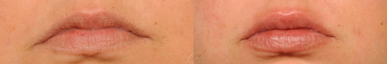 Juvederm™ Case 1518 Before & After View #1 | Serving Rochester, Syracuse & Buffalo, NY | Quatela Center for Plastic Surgery