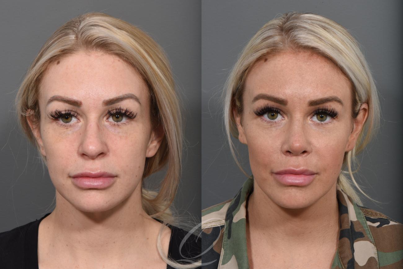 Lip Lift Case 1435 Before & After Front | Serving Rochester, Syracuse & Buffalo, NY | Quatela Center for Plastic Surgery