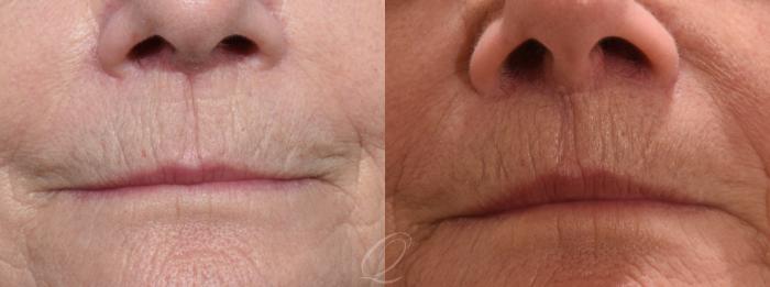Lip Lift Case 1001582 Before & After Front | Serving Rochester, Syracuse & Buffalo, NY | Quatela Center for Plastic Surgery