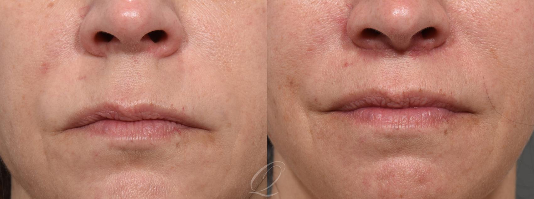 Lip Lift Case 1001583 Before & After Front | Serving Rochester, Syracuse & Buffalo, NY | Quatela Center for Plastic Surgery