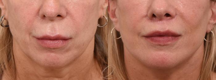 Lip Lift Case 1001608 Before & After Front | Serving Rochester, Syracuse & Buffalo, NY | Quatela Center for Plastic Surgery