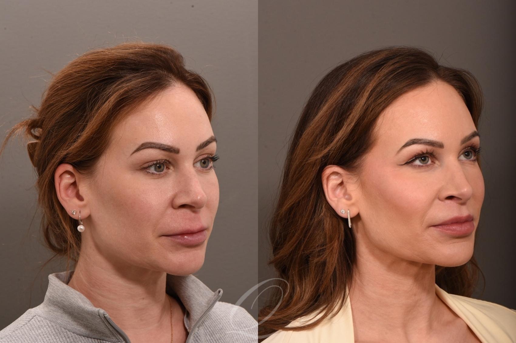 Lip Lift Case 1001864 Before & After Left Oblique | Serving Rochester, Syracuse & Buffalo, NY | Quatela Center for Plastic Surgery