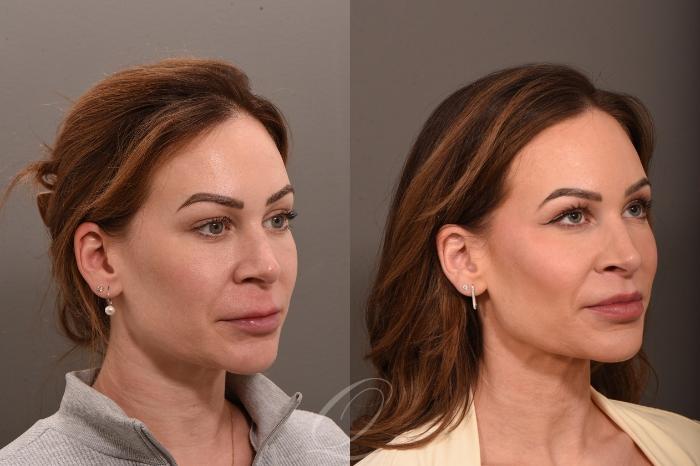Lip Lift Case 1001864 Before & After Left Oblique | Serving Rochester, Syracuse & Buffalo, NY | Quatela Center for Plastic Surgery