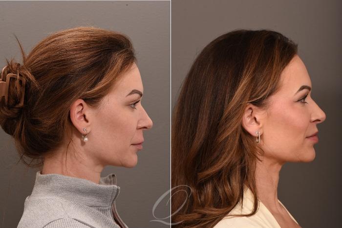 Lip Lift Case 1001864 Before & After Right Oblique | Serving Rochester, Syracuse & Buffalo, NY | Quatela Center for Plastic Surgery