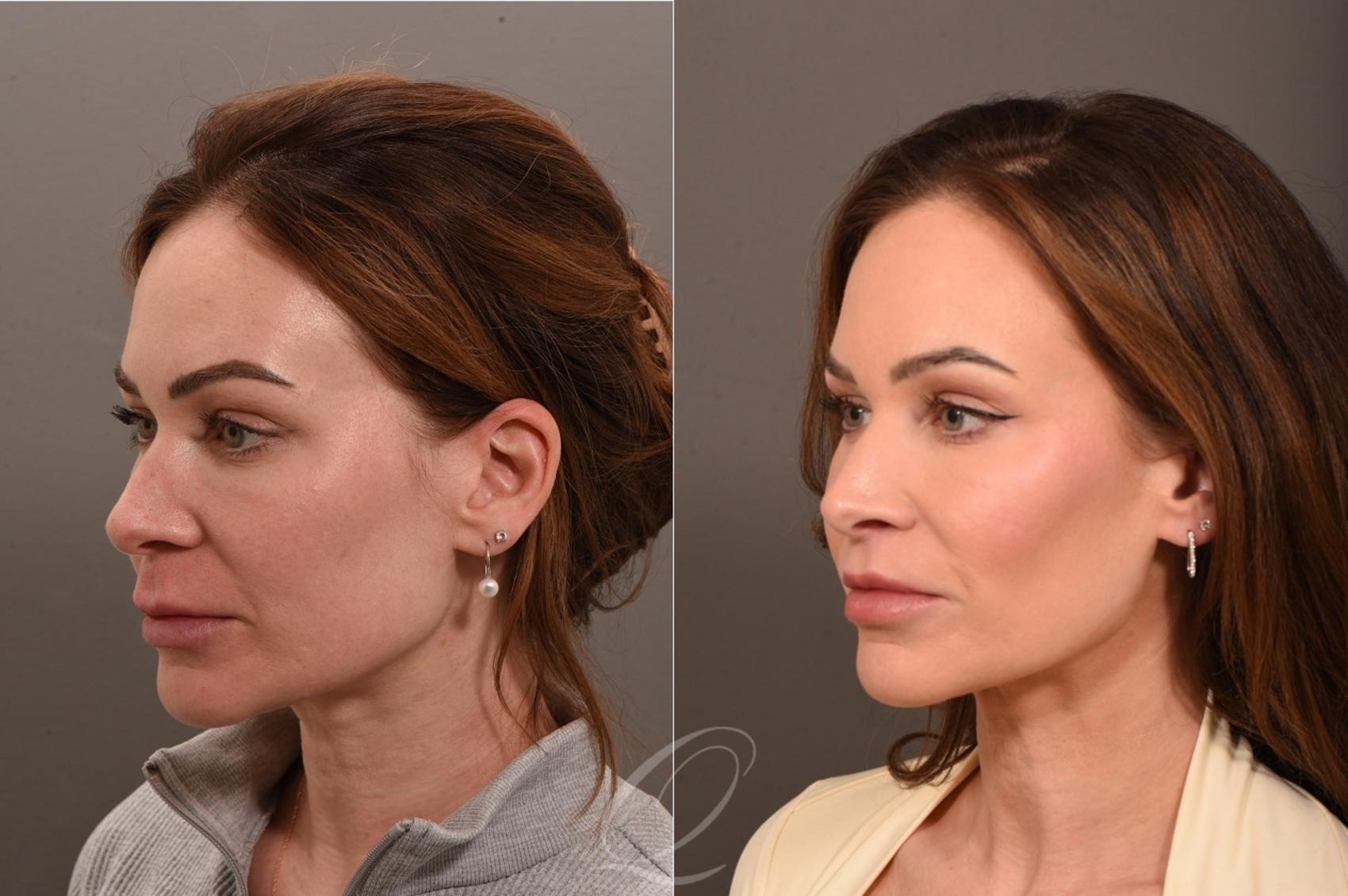 Lip Lift Case 1001864 Before & After Right Side | Serving Rochester, Syracuse & Buffalo, NY | Quatela Center for Plastic Surgery