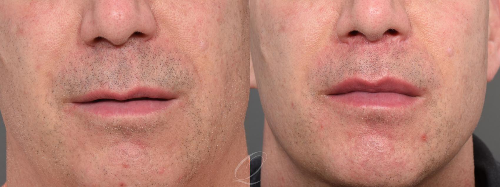 Lip Lift Case 1434 Before & After Front | Serving Rochester, Syracuse & Buffalo, NY | Quatela Center for Plastic Surgery