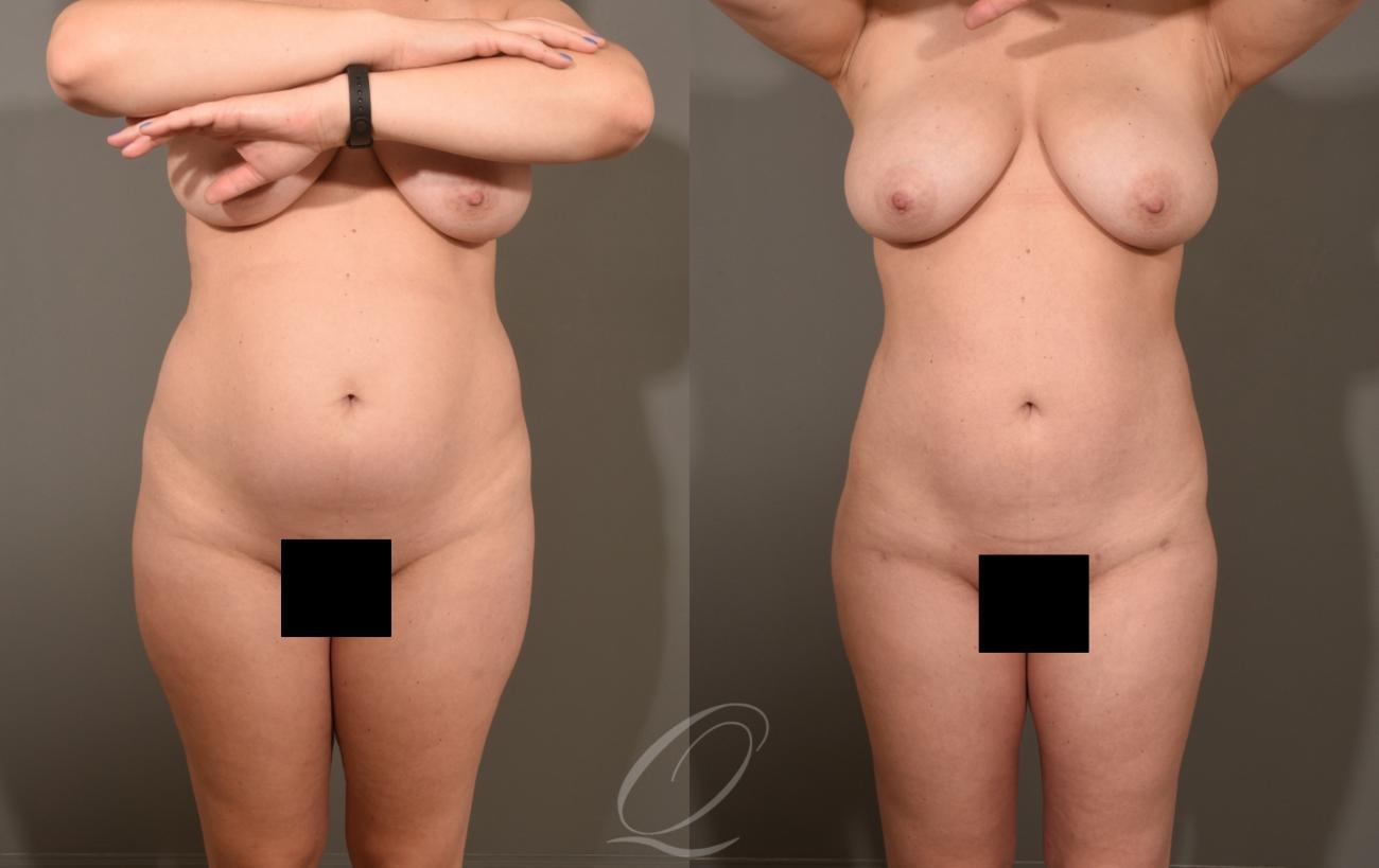 Liposuction Case 413 Before & After Front | Serving Rochester, Syracuse & Buffalo, NY | Quatela Center for Plastic Surgery