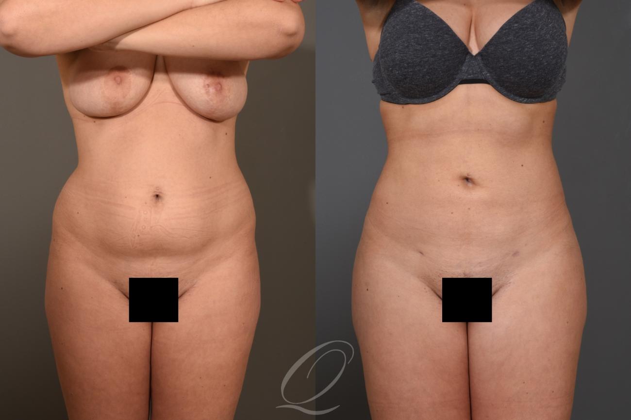 Liposuction Case 1001462 Before & After Front | Serving Rochester, Syracuse & Buffalo, NY | Quatela Center for Plastic Surgery