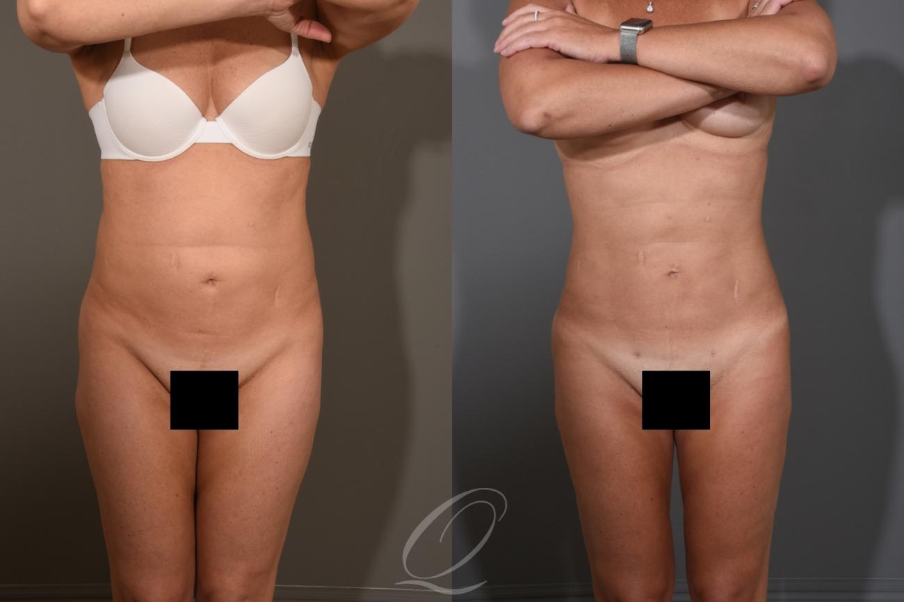 Liposuction Case 1476 Before & After Front | Serving Rochester, Syracuse & Buffalo, NY | Quatela Center for Plastic Surgery