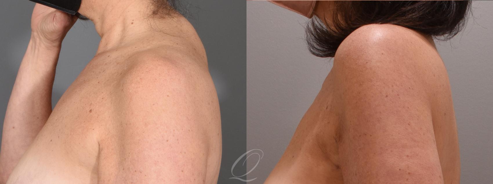 Liposuction Case 1001526 Before & After Left Side | Serving Rochester, Syracuse & Buffalo, NY | Quatela Center for Plastic Surgery
