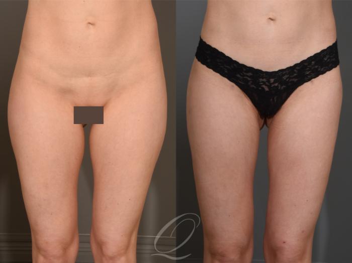 Liposuction Case 1001591 Before & After Front | Serving Rochester, Syracuse & Buffalo, NY | Quatela Center for Plastic Surgery