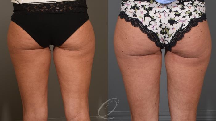 Liposuction Case 1001613 Before & After Back | Serving Rochester, Syracuse & Buffalo, NY | Quatela Center for Plastic Surgery