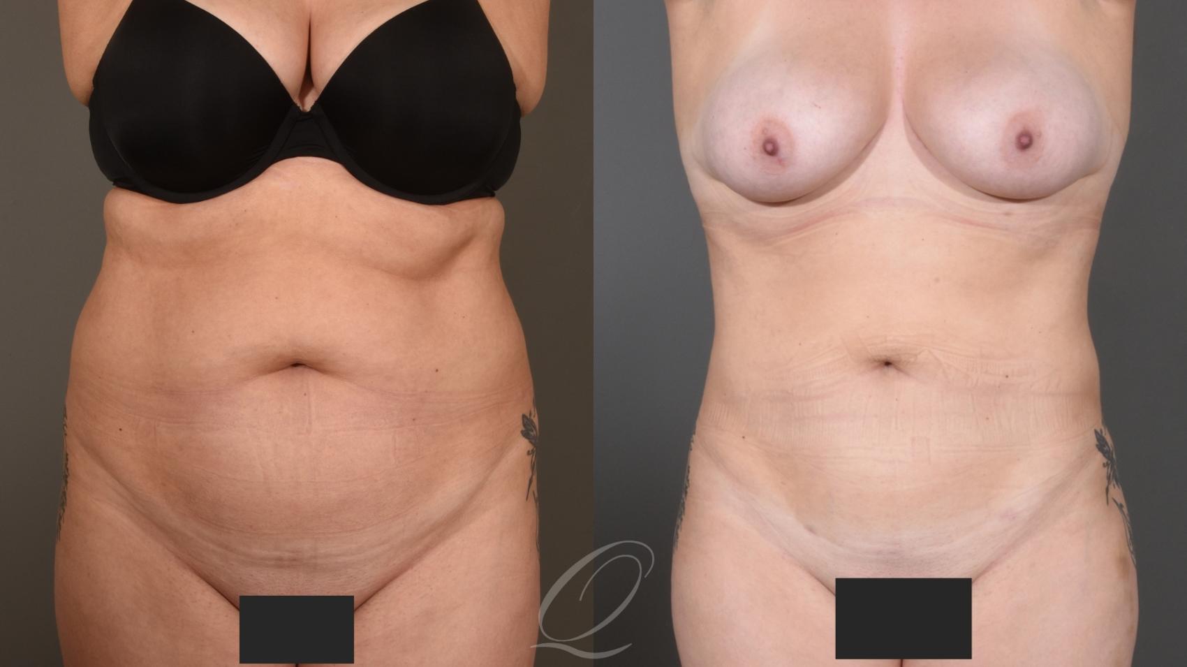 Liposuction Case 1001614 Before & After Front | Serving Rochester, Syracuse & Buffalo, NY | Quatela Center for Plastic Surgery
