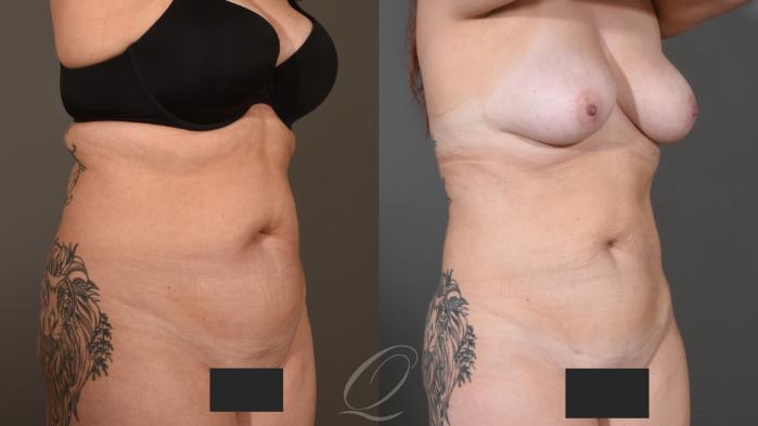 Liposuction Case 1001614 Before & After Left Oblique | Serving Rochester, Syracuse & Buffalo, NY | Quatela Center for Plastic Surgery