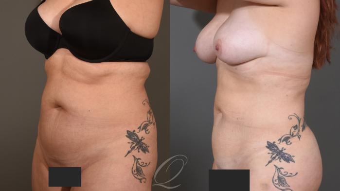Liposuction Case 1001614 Before & After Right Oblique | Serving Rochester, Syracuse & Buffalo, NY | Quatela Center for Plastic Surgery