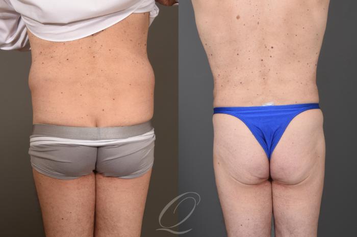 Liposuction Case 1001788 Before & After Back | Serving Rochester, Syracuse & Buffalo, NY | Quatela Center for Plastic Surgery