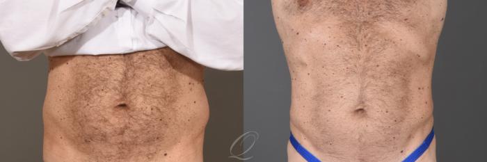 Liposuction Case 1001788 Before & After Front | Serving Rochester, Syracuse & Buffalo, NY | Quatela Center for Plastic Surgery