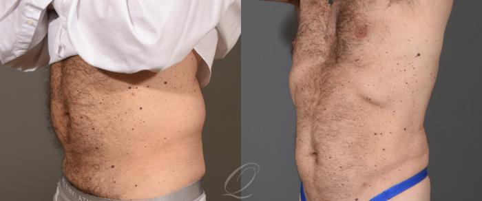 Liposuction Case 1001788 Before & After Left Oblique | Serving Rochester, Syracuse & Buffalo, NY | Quatela Center for Plastic Surgery