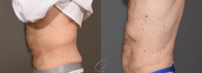 Liposuction Case 1001788 Before & After Left Side | Serving Rochester, Syracuse & Buffalo, NY | Quatela Center for Plastic Surgery