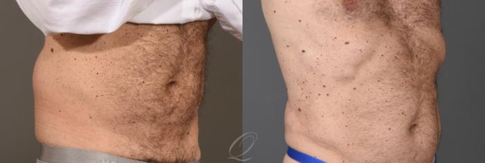 Liposuction Case 1001788 Before & After Right Oblique | Serving Rochester, Syracuse & Buffalo, NY | Quatela Center for Plastic Surgery