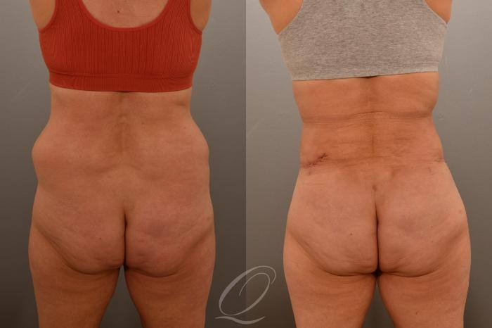 Liposuction Case 1001796 Before & After Back | Serving Rochester, Syracuse & Buffalo, NY | Quatela Center for Plastic Surgery