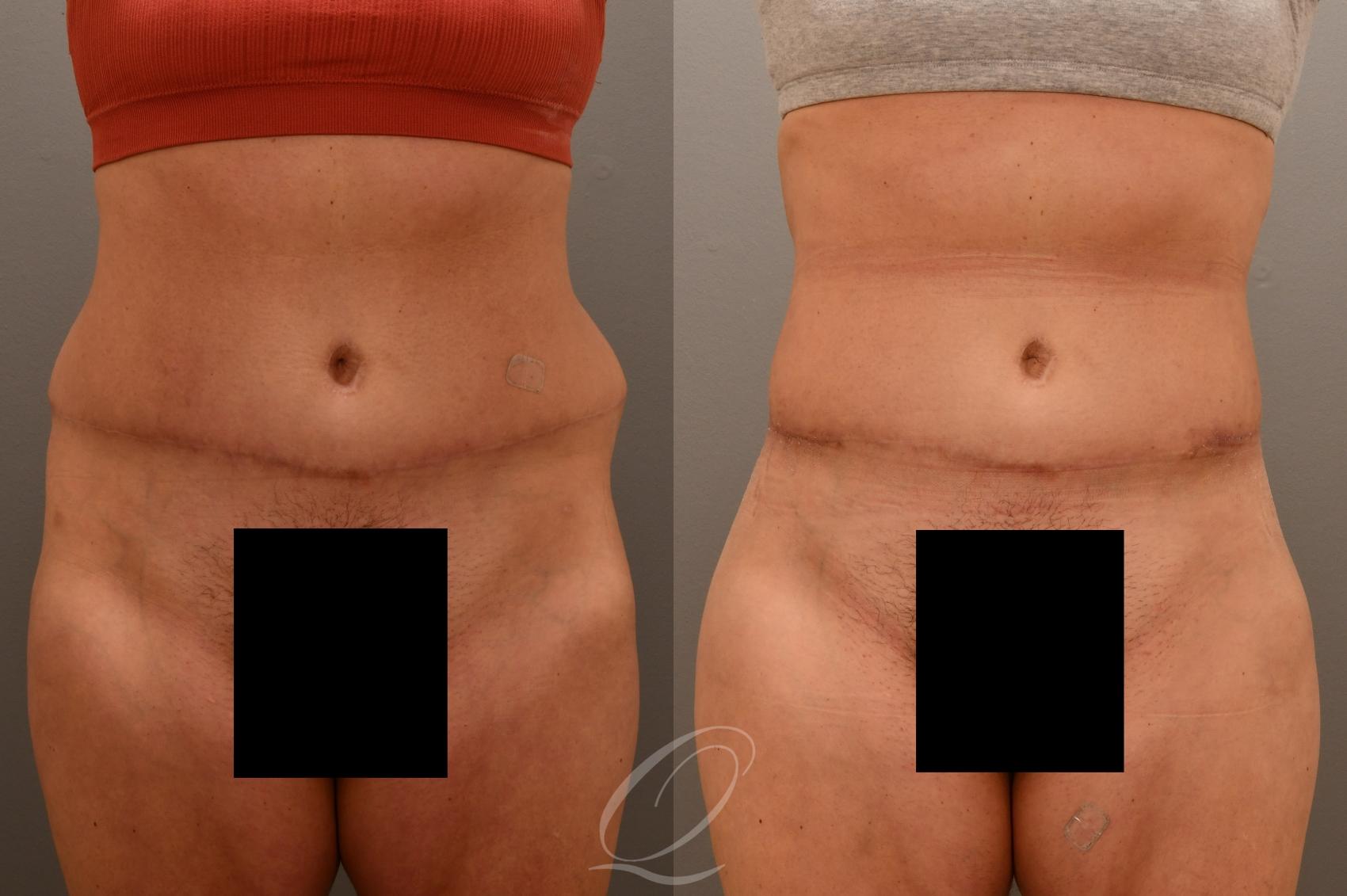 Liposuction Case 1001796 Before & After Front | Serving Rochester, Syracuse & Buffalo, NY | Quatela Center for Plastic Surgery