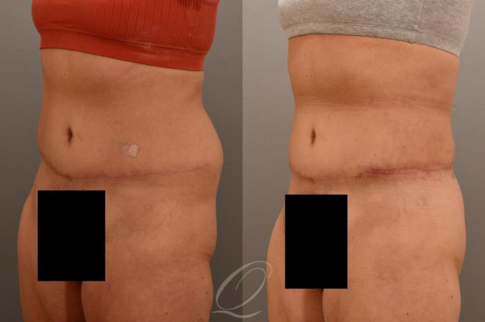 Liposuction Case 1001796 Before & After Left Oblique | Serving Rochester, Syracuse & Buffalo, NY | Quatela Center for Plastic Surgery