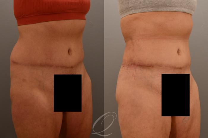 Liposuction Case 1001796 Before & After Right Oblique | Serving Rochester, Syracuse & Buffalo, NY | Quatela Center for Plastic Surgery