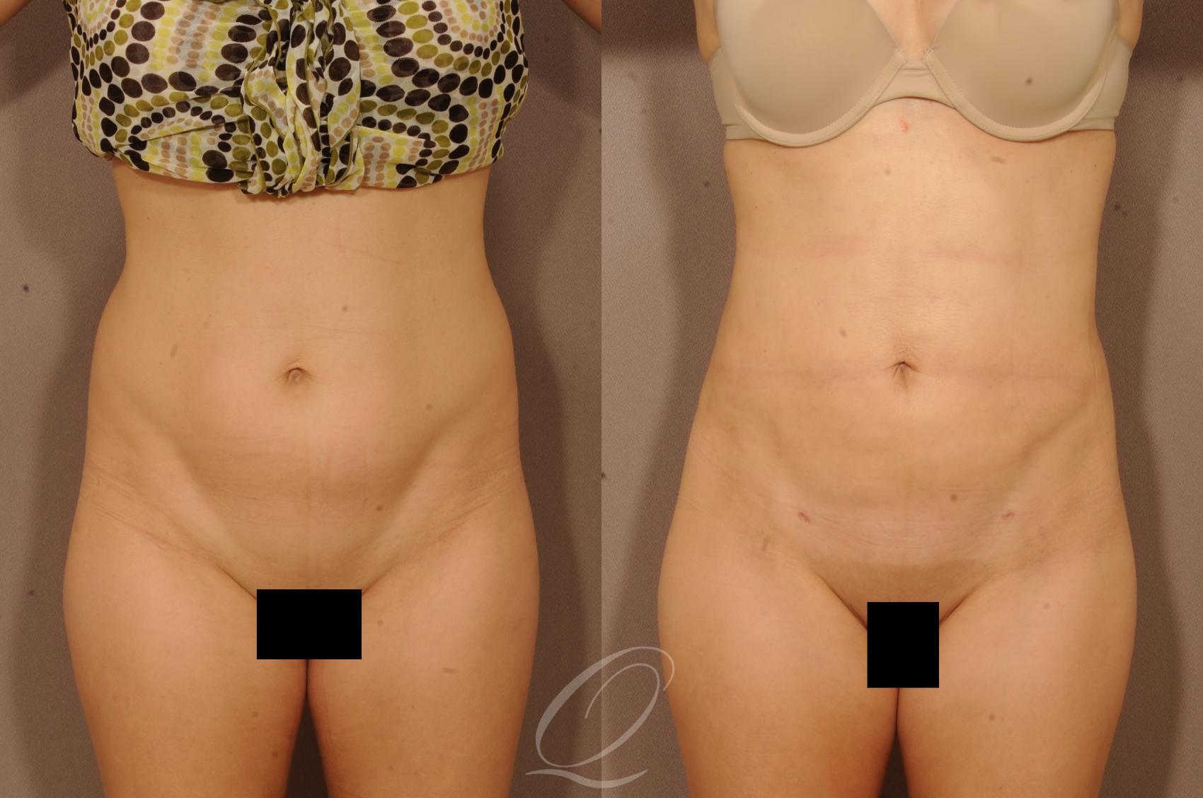 Liposuction Case 1118 Before & After View #1 | Serving Rochester, Syracuse & Buffalo, NY | Quatela Center for Plastic Surgery
