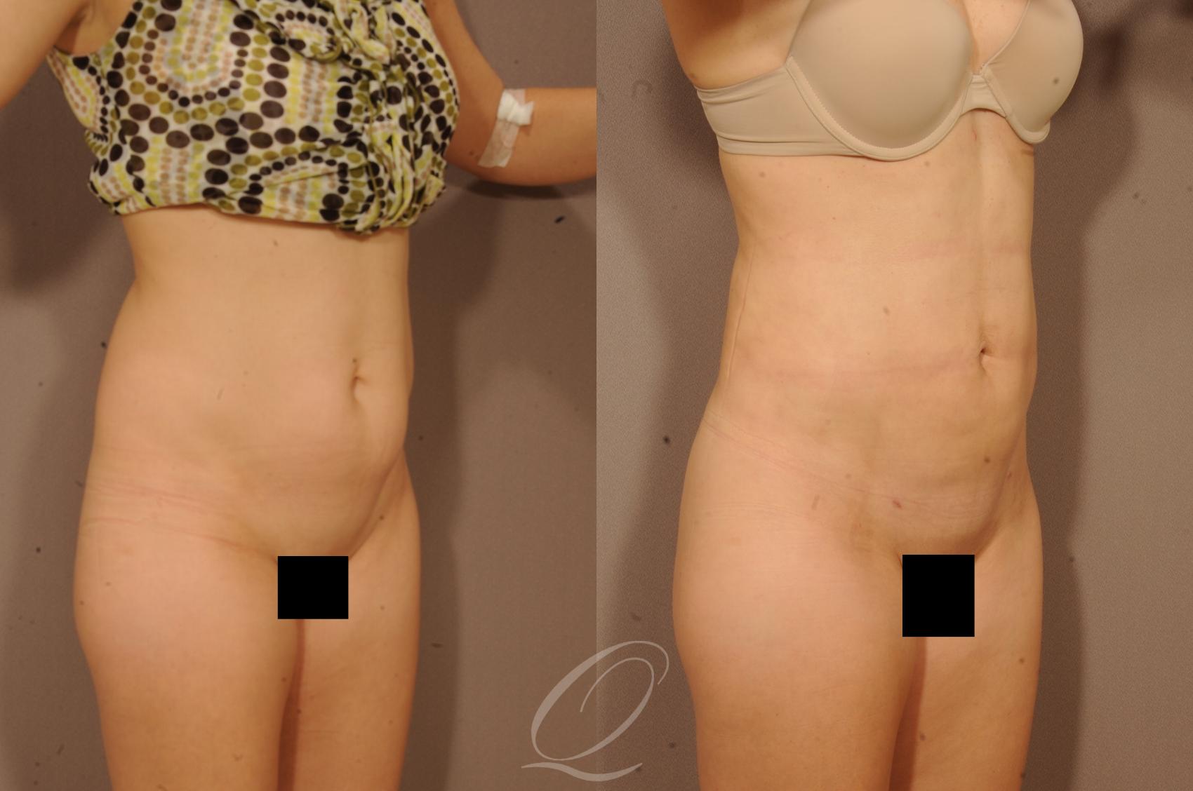 Liposuction Case 1118 Before & After View #2 | Serving Rochester, Syracuse & Buffalo, NY | Quatela Center for Plastic Surgery
