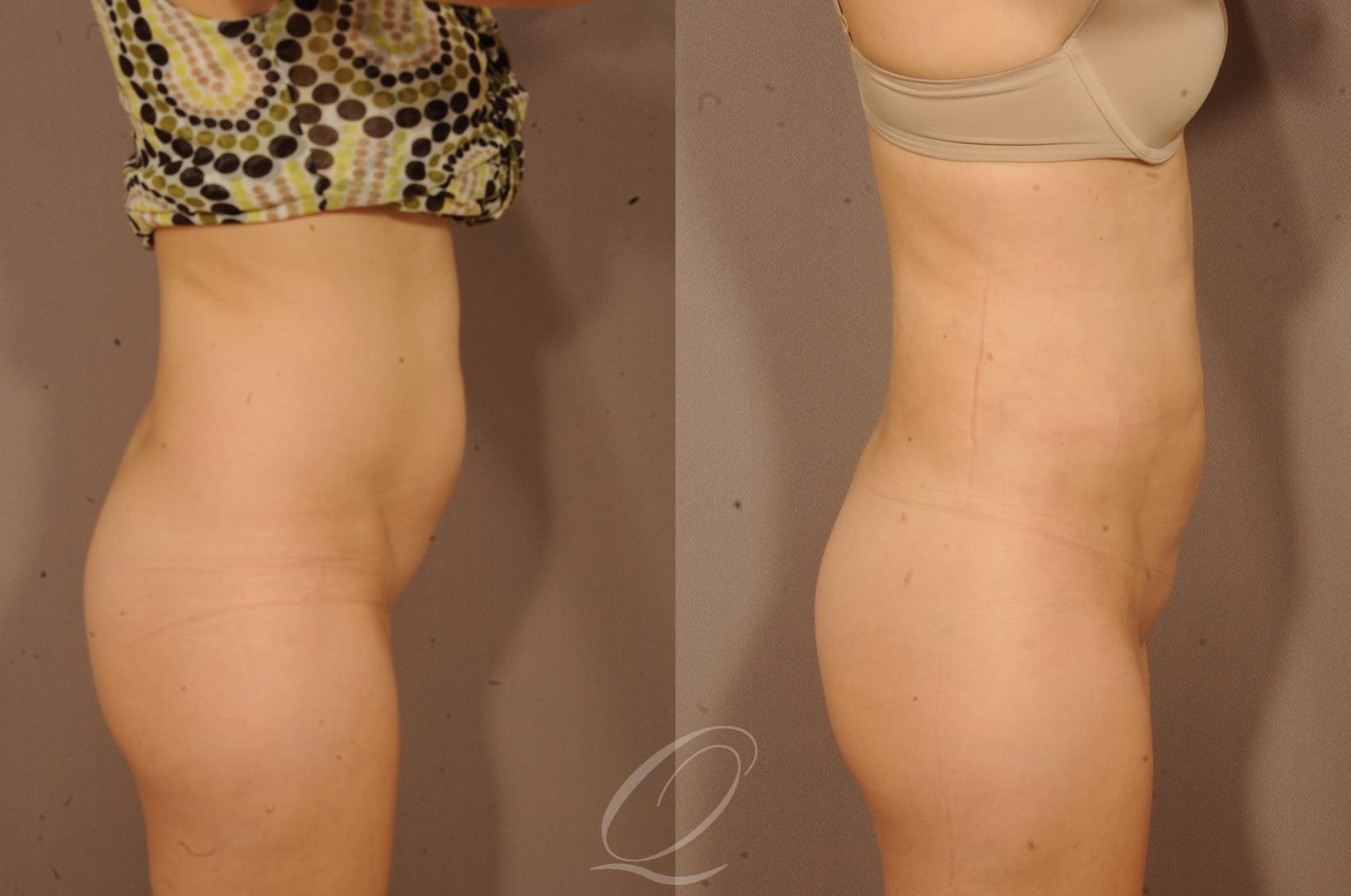 Liposuction Case 1118 Before & After View #3 | Serving Rochester, Syracuse & Buffalo, NY | Quatela Center for Plastic Surgery
