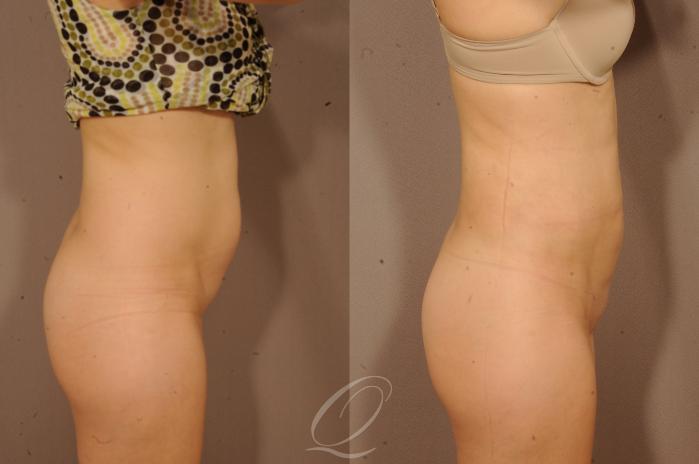 Liposuction Case 1118 Before & After View #3 | Serving Rochester, Syracuse & Buffalo, NY | Quatela Center for Plastic Surgery