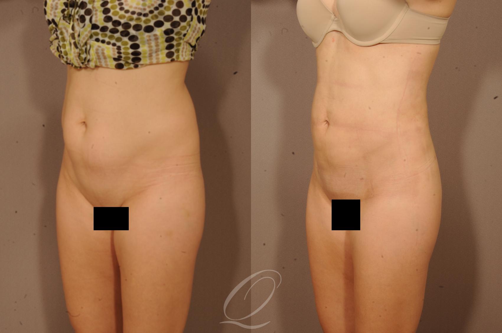 Liposuction Case 1118 Before & After View #4 | Serving Rochester, Syracuse & Buffalo, NY | Quatela Center for Plastic Surgery