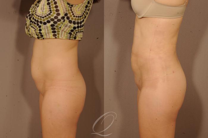 Liposuction Case 1118 Before & After View #5 | Serving Rochester, Syracuse & Buffalo, NY | Quatela Center for Plastic Surgery