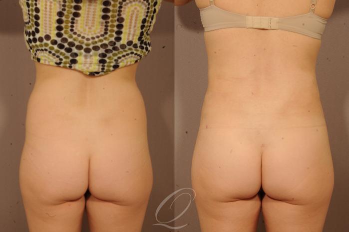 Liposuction Case 1118 Before & After View #6 | Serving Rochester, Syracuse & Buffalo, NY | Quatela Center for Plastic Surgery