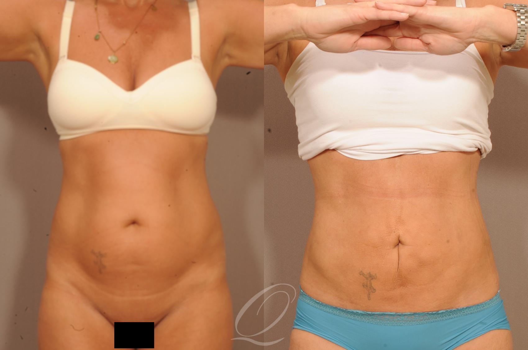 Liposuction Case 1139 Before & After View #1 | Serving Rochester, Syracuse & Buffalo, NY | Quatela Center for Plastic Surgery