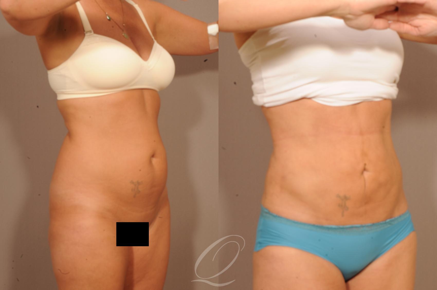 Liposuction Case 1139 Before & After View #2 | Serving Rochester, Syracuse & Buffalo, NY | Quatela Center for Plastic Surgery