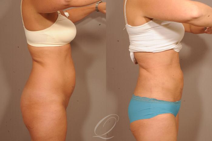 SmartLipo Laser Body Sculpting Case 1139 Before & After View #3 | Serving Rochester, Syracuse & Buffalo, NY | Quatela Center for Plastic Surgery