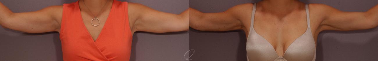 Liposuction Case 272 Before & After View #1 | Serving Rochester, Syracuse & Buffalo, NY | Quatela Center for Plastic Surgery