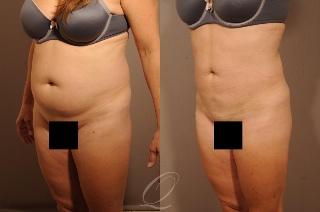 Liposuction Case 1257 Before & After View #3 | Serving Rochester, Syracuse & Buffalo, NY | Quatela Center for Plastic Surgery