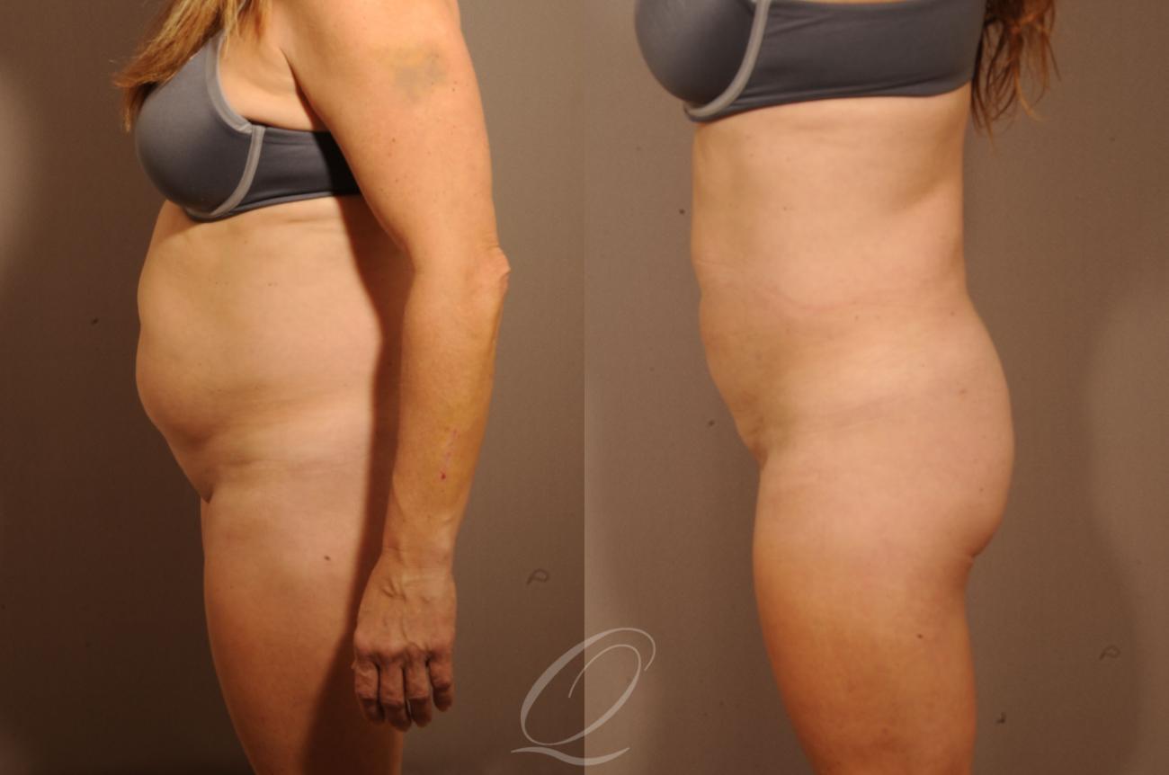 Liposuction Case 1257 Before & After View #4 | Serving Rochester, Syracuse & Buffalo, NY | Quatela Center for Plastic Surgery