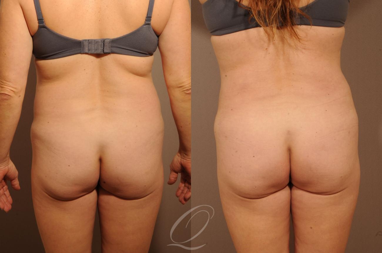 Liposuction Case 1257 Before & After View #5 | Serving Rochester, Syracuse & Buffalo, NY | Quatela Center for Plastic Surgery