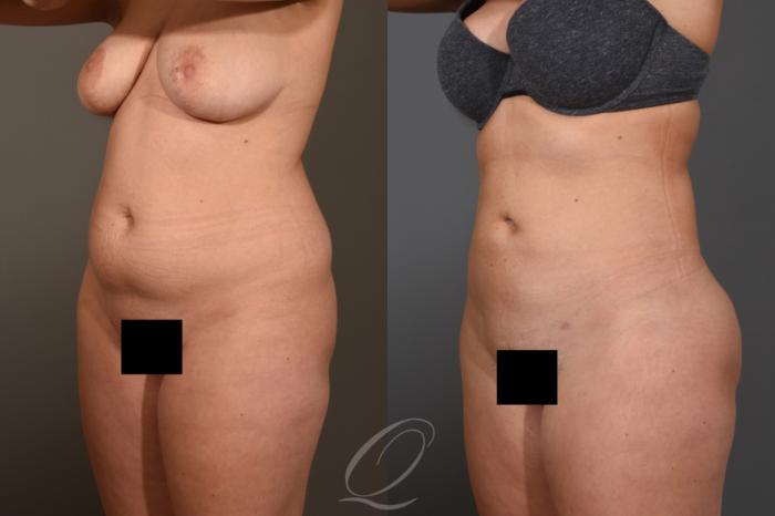 Liposuction Case 1462 Before & After Left Oblique | Serving Rochester, Syracuse & Buffalo, NY | Quatela Center for Plastic Surgery