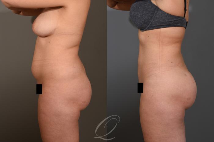 Liposuction Case 1462 Before & After Left Side | Serving Rochester, Syracuse & Buffalo, NY | Quatela Center for Plastic Surgery